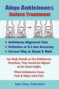 Align Anklebones Before Treatment cover